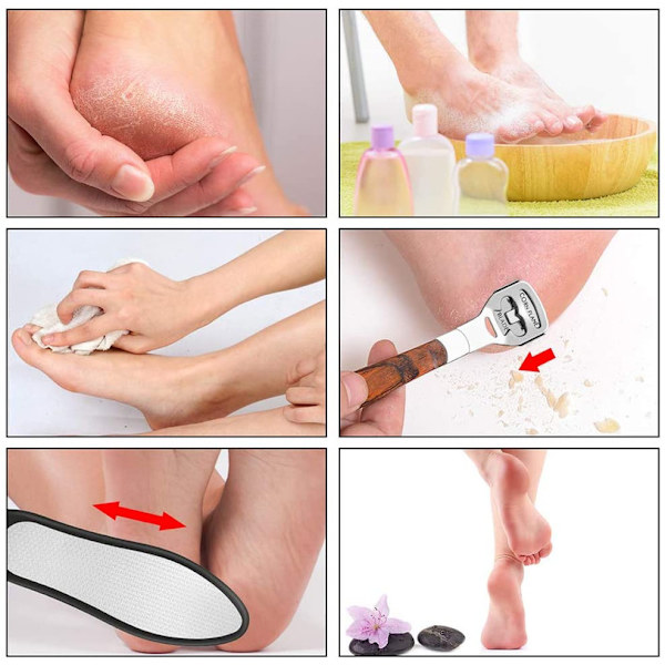 Callus Remover, Premium 5-delad Callus Rasp Set