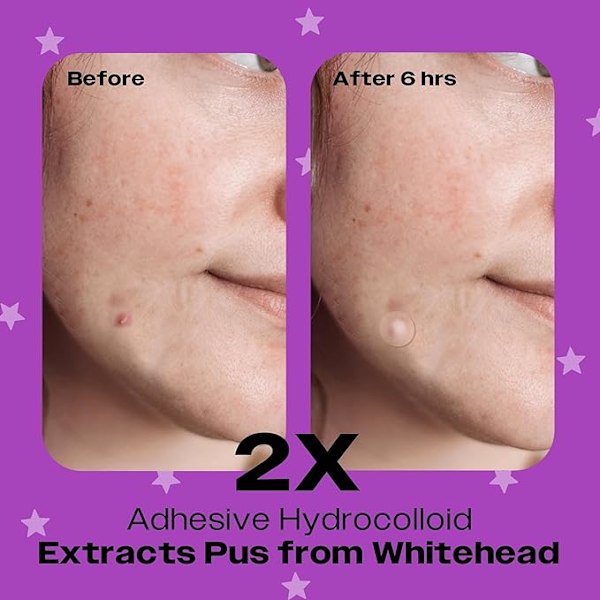 Acne finne lapp absorberande överdrag fläck (PM övernattning/24 patter)