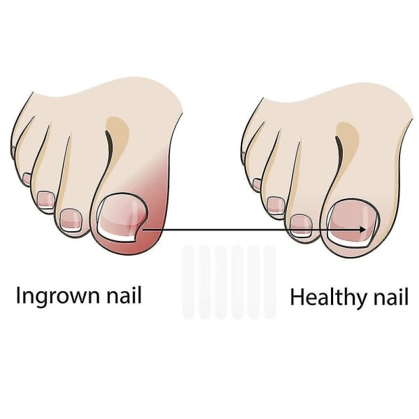 10 indgroede tåneglekorrektionsstrimler - ret tånegle til sunde negle