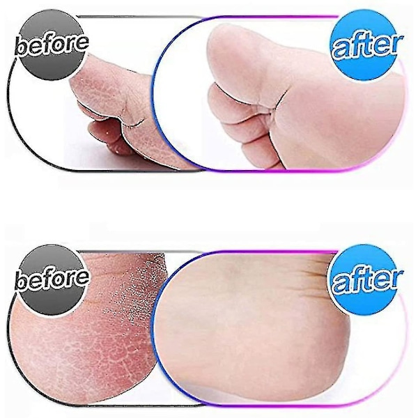 Super Grov Mikromineral Udskiftningsruller Kompatible med Em Micro Pedi Callus Remover (1 stk, Grå)