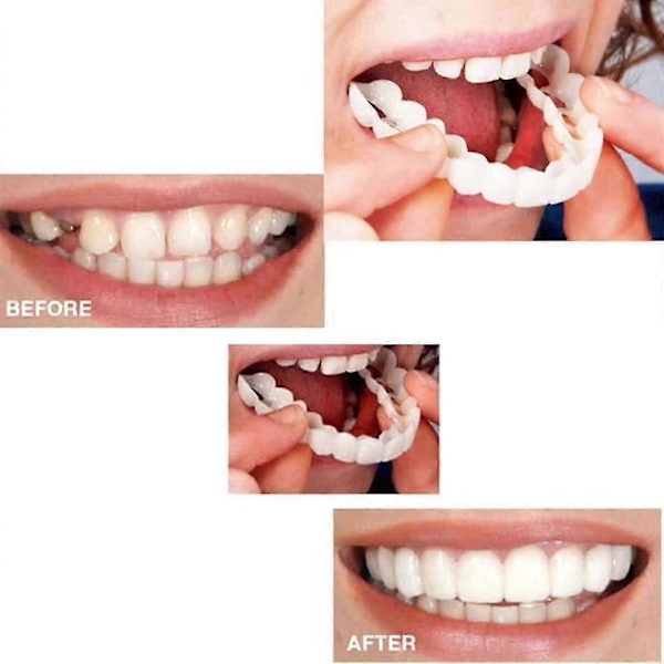 Perfect Smile Veneers Comfort Fit - Flex Tandprotespasta Tandställning
