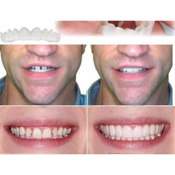 Perfect Smile Veneers Comfort Fit - Flex Tandprotespasta Tandställning