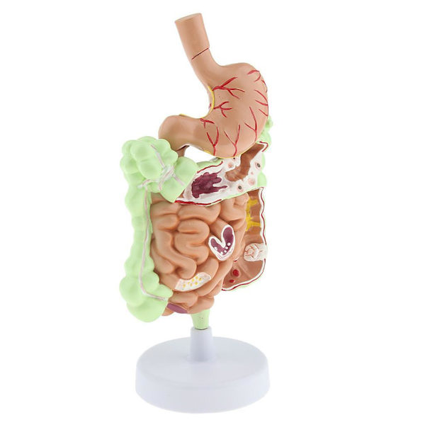 1/2/3 Omfattande mänsklig gastrointestinal patologimodell 1 Pc