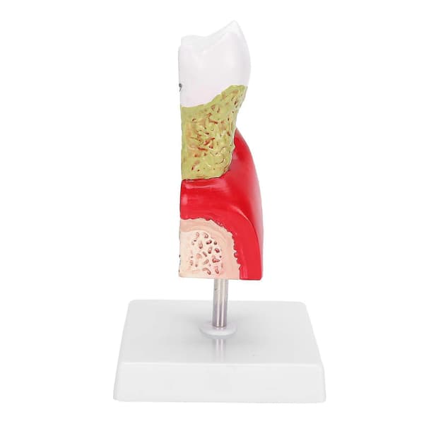 Tandmodel for caries Dental Teeth Model til undervisningstræning Patientuddannelse