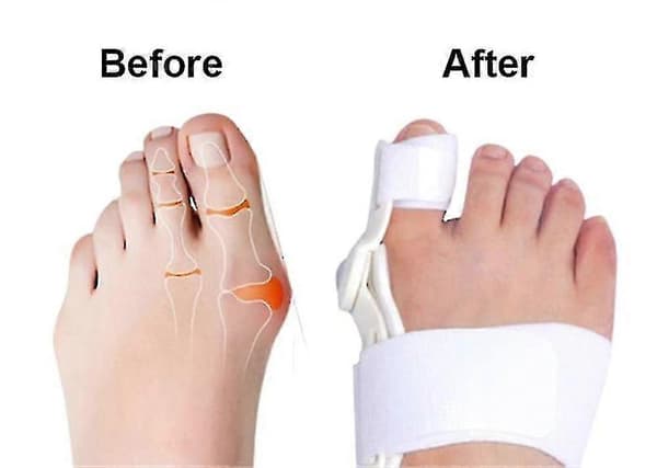 2 stk. Hallux Valgus Korrigerer for Kvinner Valgus Skinne Splintputer
