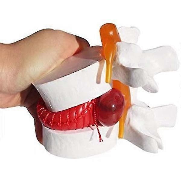 1 stk Anatomisk Lumbal Skiveprolaps Lumbal Ryggsøylemodell Hvit Farge