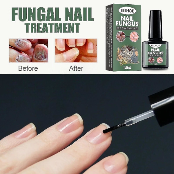 Eelhoe Nail Onycho Flydende Hånd- og Fodnegl Onychomy Pleje Reparation Negl Onyc Bx