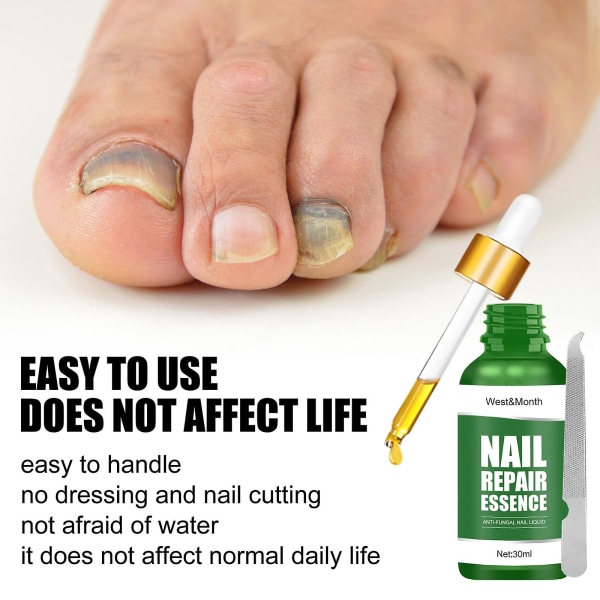 30ml Negle-svampe-behandling Antifungal Negle Liquid Fingerneglepleje Effektiv