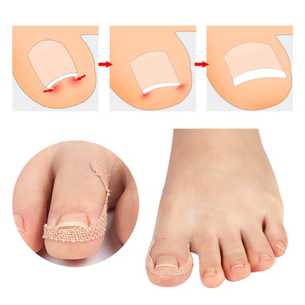 Forbedre Toe Embedded Nail Groove Relief Paste og korriger neglen 4 pcs