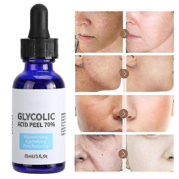Glykolsyra Peel Renhet 70% Koncentration 5% Hudreparation Osynliga porer Ljus upp hudton Behandling