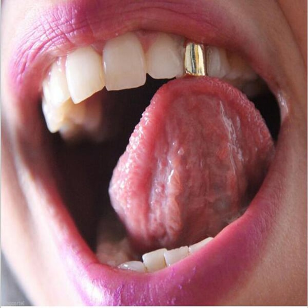 2 delar 14 k guldpläterade munständer, vanliga tänder, topptandsynd