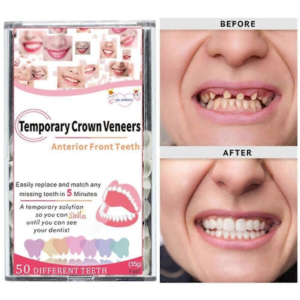 Temporär tandtejp för kronor, porslinsfasader för främre och bakre tänder front teeth