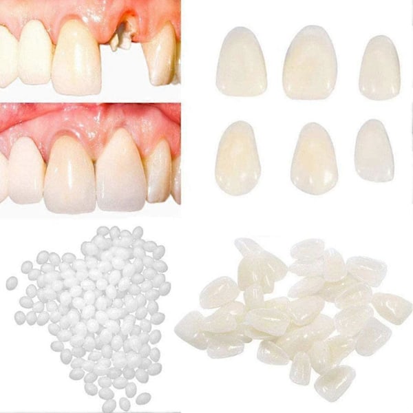 Temporär tandtejp för kronor, porslinsfasader för främre och bakre tänder front teeth