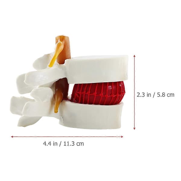 Mannequin Rygsøjle Anatomisk Model Lumbal Hvirvel Rygsøjle Model Anatomisk Lumbal Diskusprolaps Model