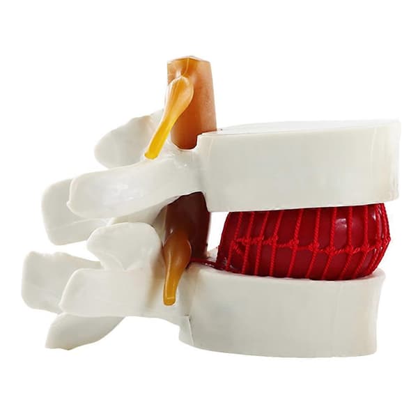 Mannequin Rygsøjle Anatomisk Model Lumbal Hvirvel Rygsøjle Model Anatomisk Lumbal Diskusprolaps Model