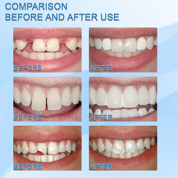 Dental trådløs guttaperka tandkødsskærer indre tænder guttaperka cutter + 4 tips