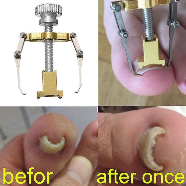 Huafei ortopediska klistermärken 6-delad set korrigerande lapp Inåtväxande nagelkorrigerare Pedikyrverktyg