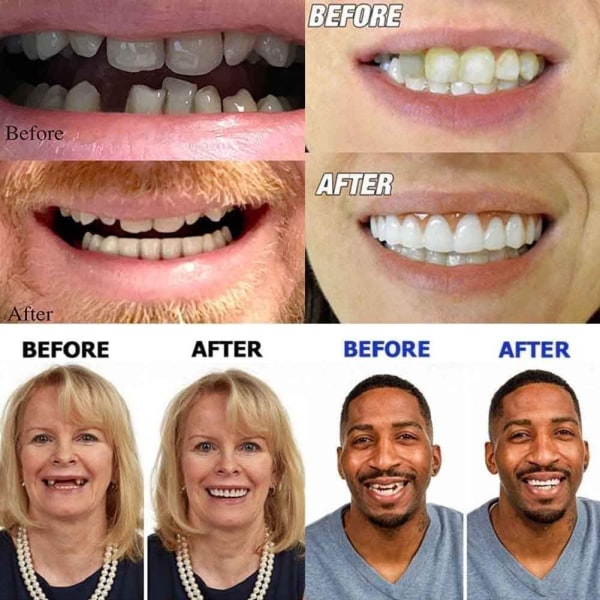 Künstliche Zähne Zahnersatz Provisorischer Quick Dental Prothe