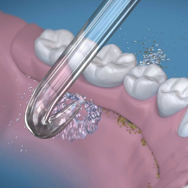 2 Vaihtokärkeä Implanttihammasproteeseihin