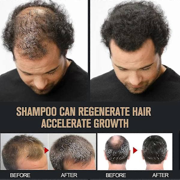 Root Activator Shampoo, Mane Root Activator Shampoo, Schampo Root Activator Främjar hårväxt för män Hårförtjockningsschampo - sju 2st 2pcs