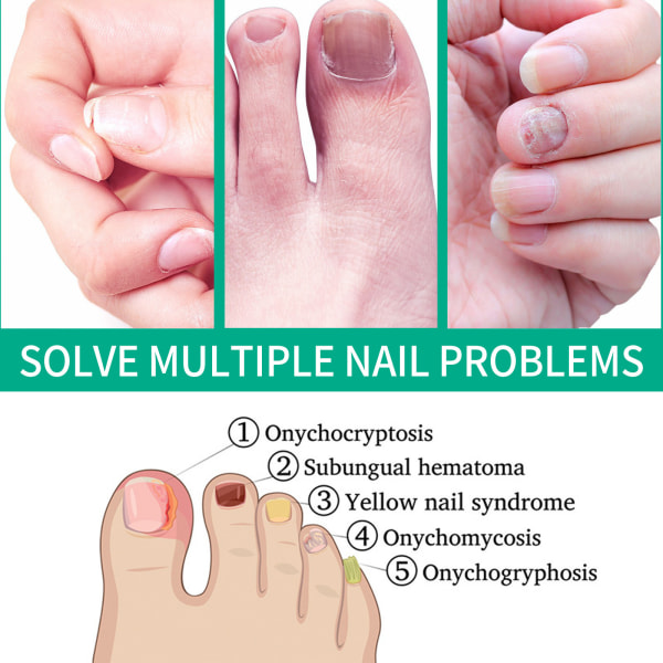 Nagelreparation, finger- och tånagelreparation, maximal styrka nagellösning, reparerar och skyddar tånagel och fingernagel från missfärgning, spröd och