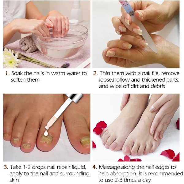 Tånagel för tånagel eller fingernagel Nagelreparationslösning Nagelförnyande vätska för skadad missfärgande nagel