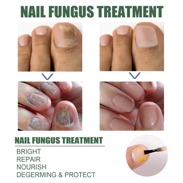 Extra Strength Nagelreparationsvätska för tånagel och fingernagel, Nagelreparationslösning för tjocka spruckna missfärgade naglar, Återställ friska naglar