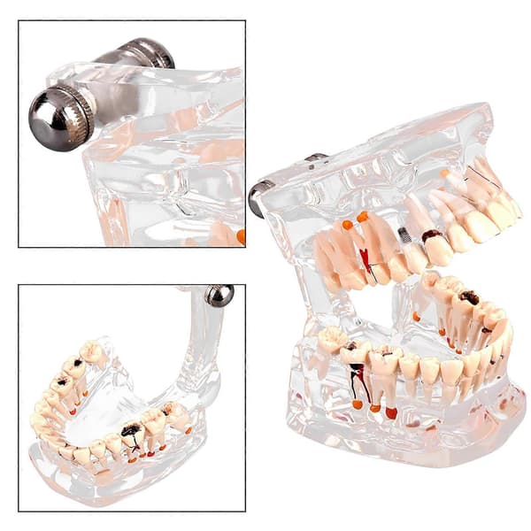 Ny Dental Undervisning Studie Standard Tandmodell Demonstration Sjukdom Utbildning