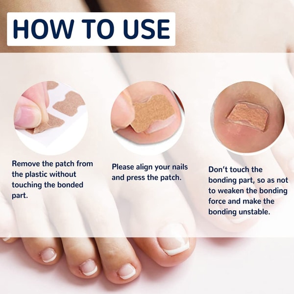Behandling av inåtväxande tånagel, 50 st inväxta tånagelkorrigeringsremsor, säkra effektiva smärtfria pedikyrverktyg Lämplig för alla nagelstorlekar style1