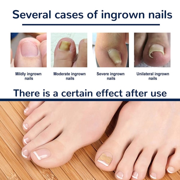 Behandling av inåtväxande tånagel, 50 st inväxta tånagelkorrigeringsremsor, säkra effektiva smärtfria pedikyrverktyg Lämplig för alla nagelstorlekar style1