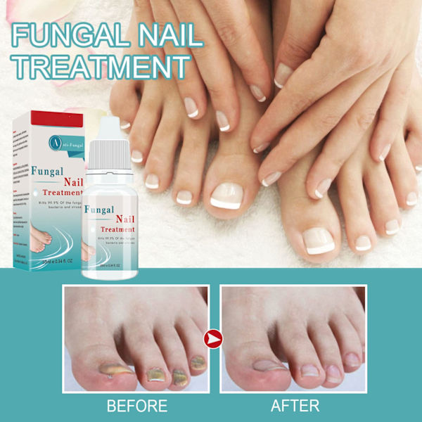 Nagelvårdslösning Runjiajing Mjuk Nagelreparation Onychomycosis Hand- och Fotnäring, 1 st
