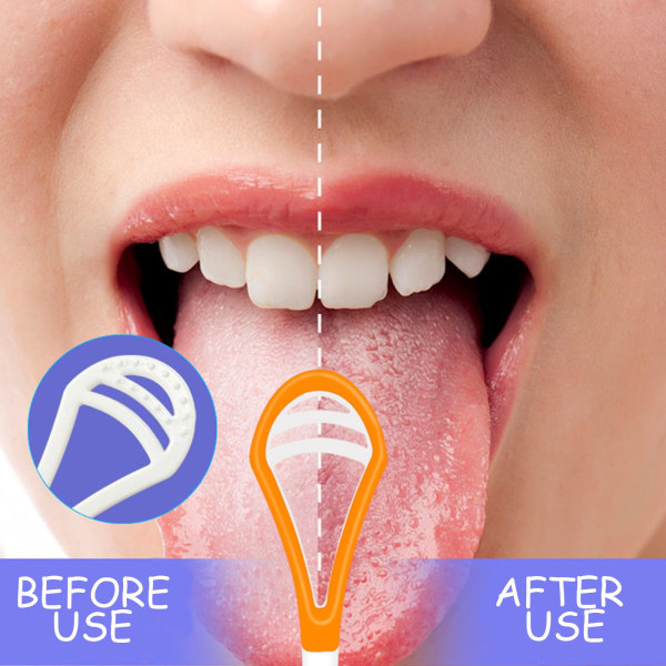 5 delar tungskrapa, tungrengöring, bärbar tungskrapa, tungskrapa, tungskrapa oral självvård