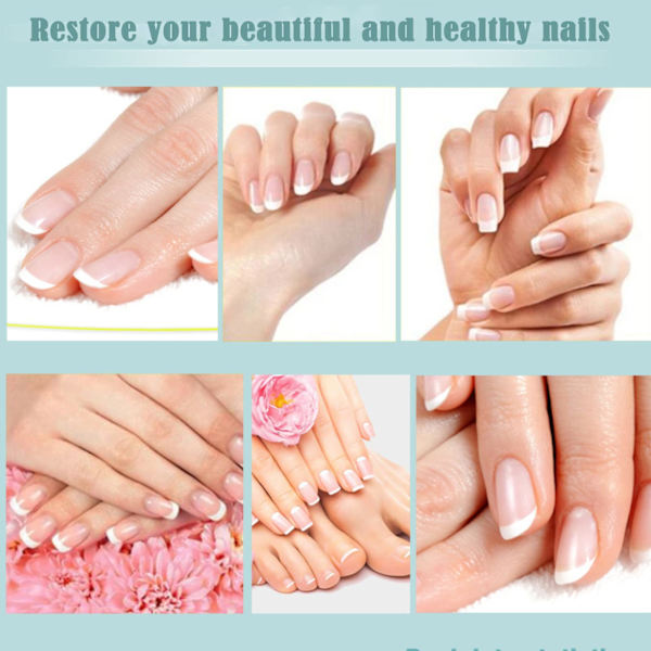 Nagelvårdslösning Runjiajing Mjuk Nagelreparation Onychomycosis Hand- och Fotnäring, 1 st