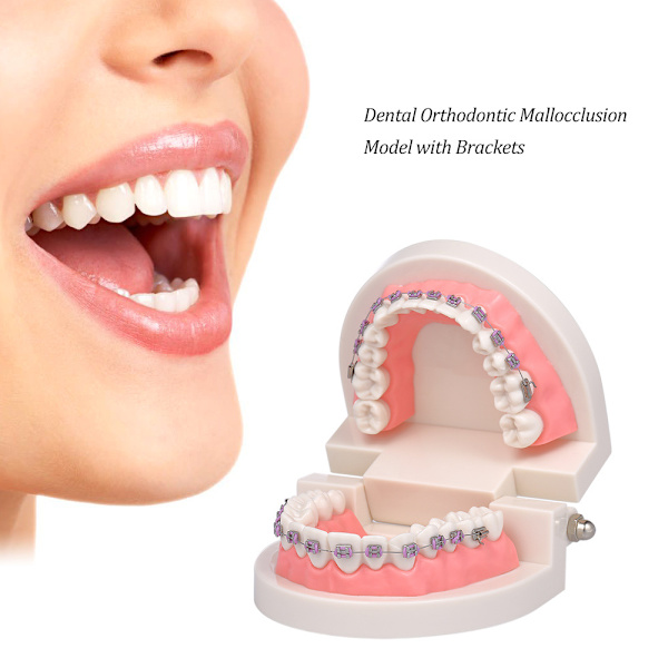 Tandmodell för Malocclusion med Ortopediska Stöd
