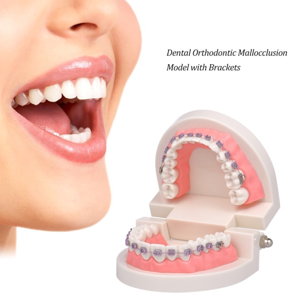 Tandmodeller Malocclusion Orthodontisk Model med Metal Brackets