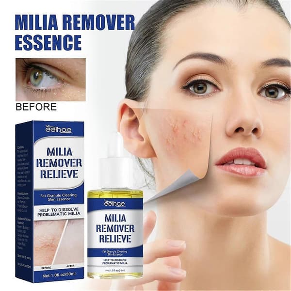 Miliafjerner, Milia til øjne, Milia, Talg 30ml