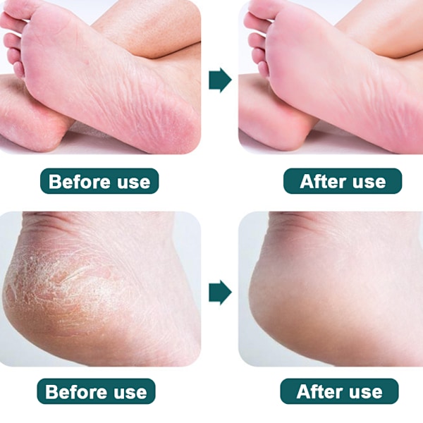 Pedicure Rasp Fodfil, Professionel Fodpleje Pedicure Rustfrit Stålfil Til Fjernelse Af Hård Hud.Sort