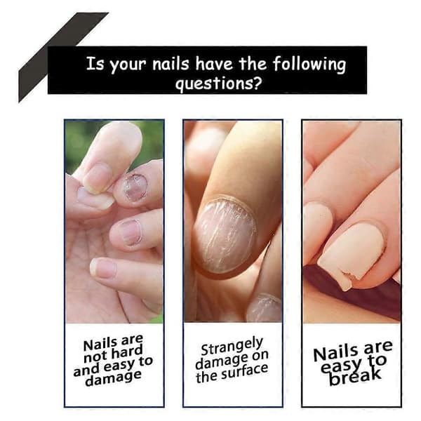 Onycholysis Heal Negleforstærkende og Vækstbalsam, Onycholysis Neglebehandling, Onycholys