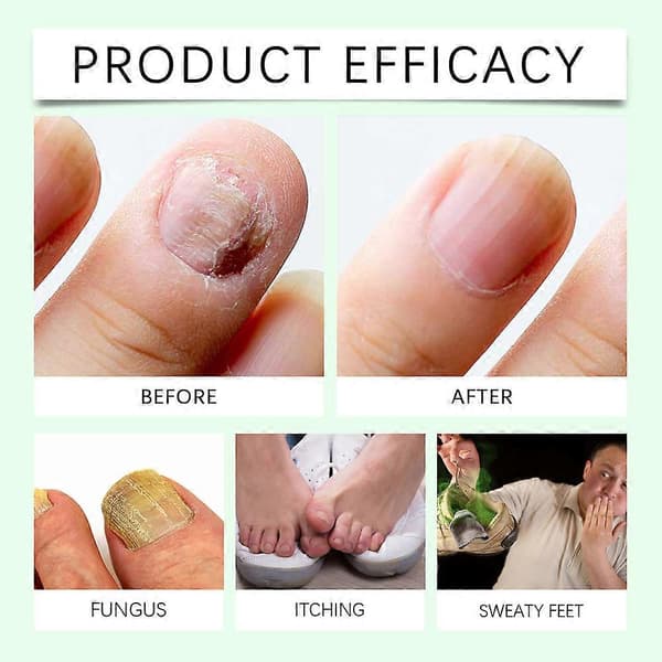 7-dagars Tea Tree Ingefära Nagelväxtessens, Svampdödande Nagel- och Tånagelvårdslösning 2