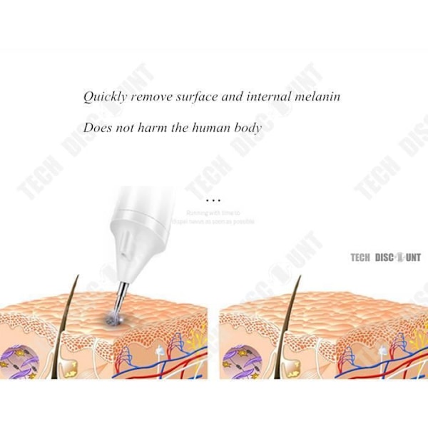 TD® stil brun plet hud rødme skønheds fjernelse apparat maskine sorte kit hygiejne massage vorte urenheder billigt kvinder