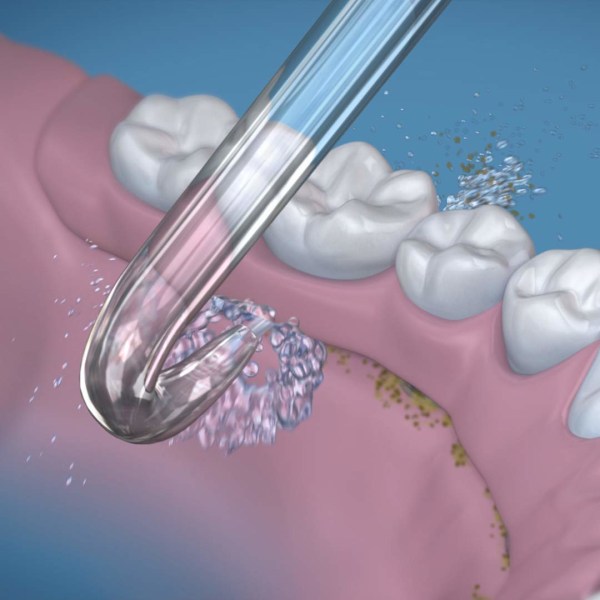 2 tæller implantatproteseudskiftningsspidser Vandtrådsspids Repla