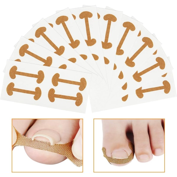 Nagelkorrigerande klistermärken 40 st Paronychia nagelbehandling återhämtning