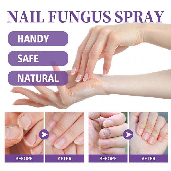 Jaysuing Grå Nagel Vård Spray Mjuka Inåtväxta Naglar, Inåtväxta Naglar, Gulnande Och Förtjockande Rengöringsvård 100Ml