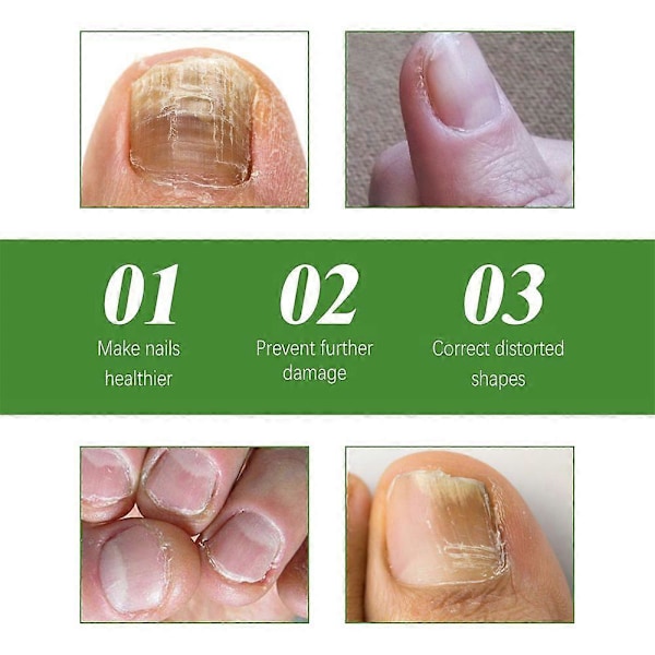1-3 st Nageloljeroller - Näringsgivande Massage För Starkare, Snabbare Växande Naglar Med 7-dagars Nagelväxtformula 2pcs