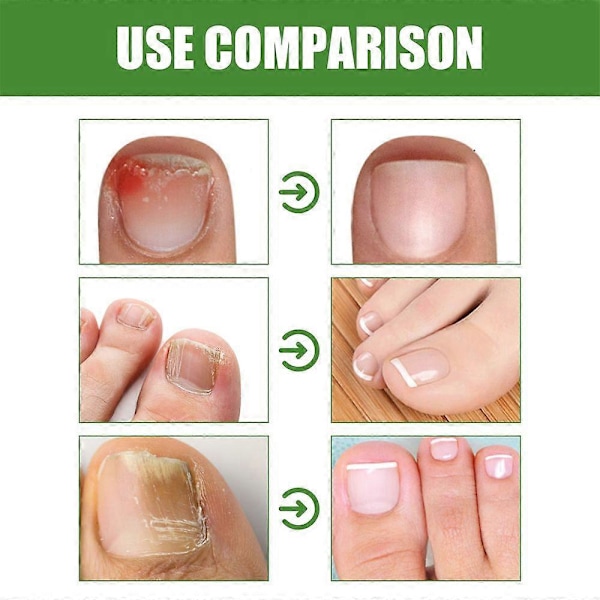 1-3 st Nageloljeroller - Näringsgivande Massage För Starkare, Snabbare Växande Naglar Med 7-dagars Nagelväxtformula 2pcs