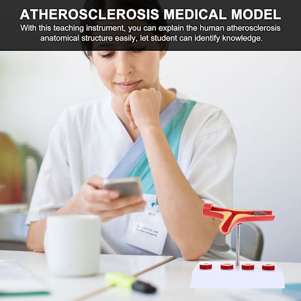 Ateroskleros Medicinsk Modell Blodkärlsanatomisk Modell Hjärt-kärlsjukdomsmodell