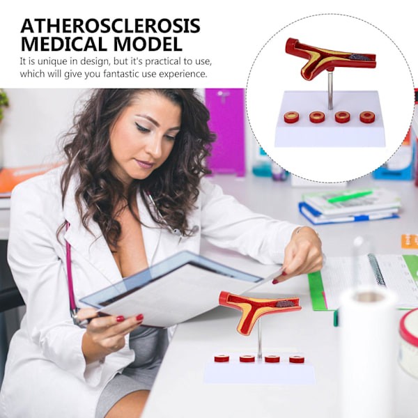 Ateroskleros Medicinsk Modell Blodkärlsanatomisk Modell Hjärt-kärlsjukdomsmodell