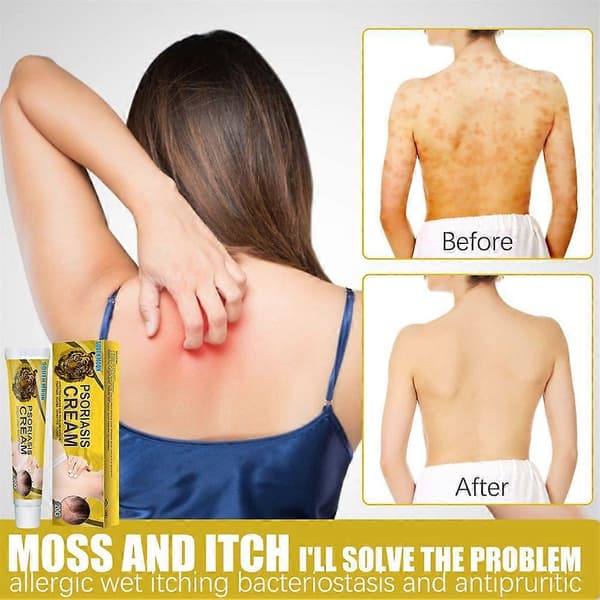 Psoriasiscreme til bakteriostase, dermatitis, eksem, kropspsoriasis, hudpleje (5 stk.)