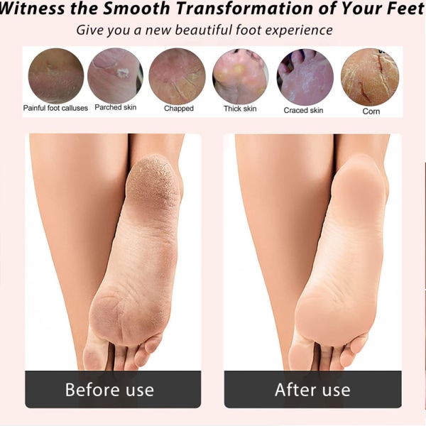 Foot Rasp Callus Remover Dead Skin Remover Dobbeltsidet fod
