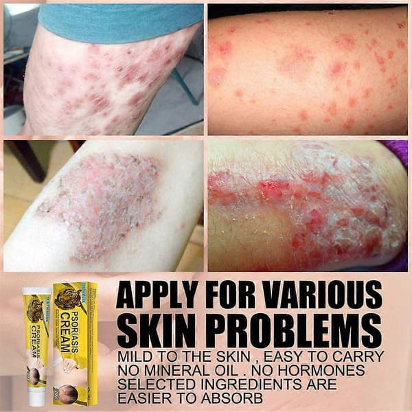 Psoriasis krem for bakteriostase dermatitt eksem kropp psoriasis hudpleie (5 stk)